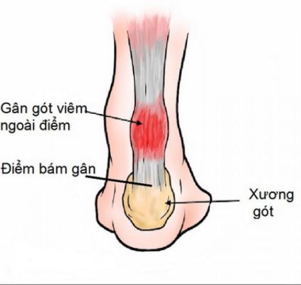 Viêm gân Achilles gây đau gót chân